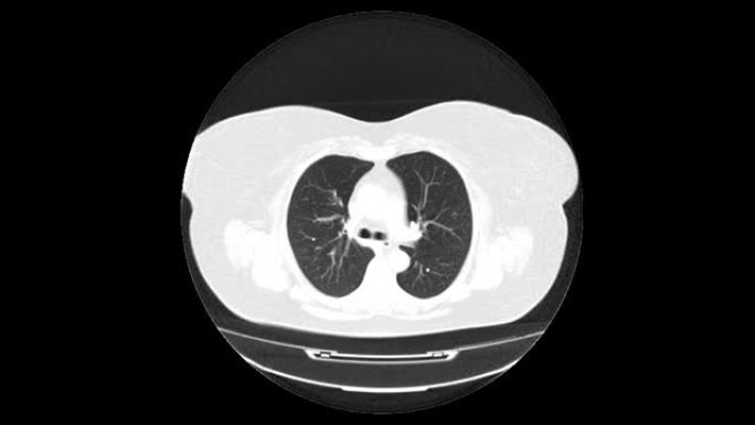 肺和支气管的MRI扫描，呼吸道疾病的诊断