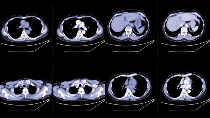 CT胸部对比造影或CTA肺动脉注射造影剂后诊断肺栓塞和肺部疾病的比较