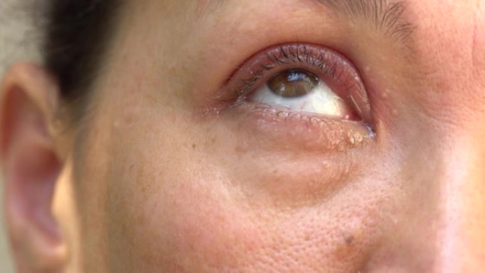 麦粒肿，麦粒肿，眼睑油腺的细菌感染。上眼睑上的肿块。眼部粘液分泌物