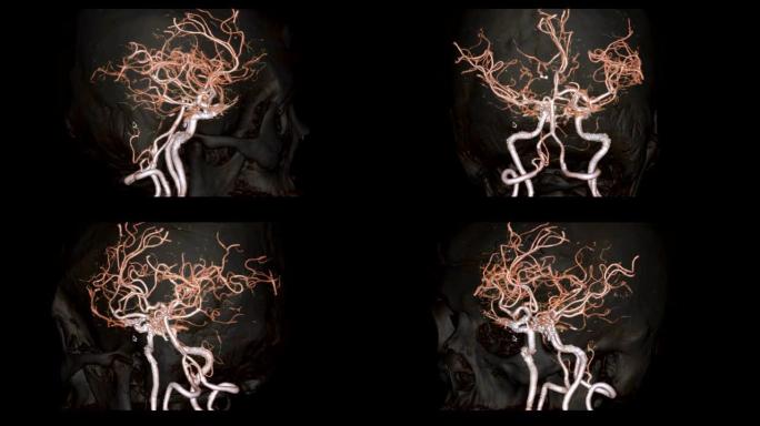 CTA脑或计算机断层扫描血管造影的大脑3D渲染图像显示大脑的脑动脉，透明的骨骼在屏幕上旋转。