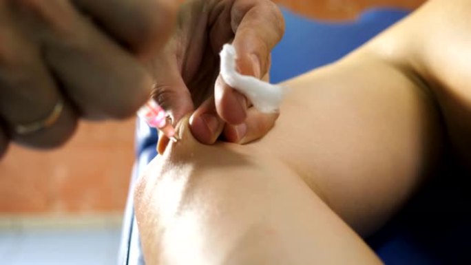 医生的男性手在医院的病人手臂上用注射器注射。临床接种疫苗后，用酒精浸湿的棉绒在年轻人的皮肤上使用医用