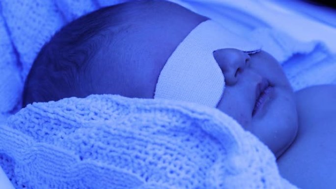新生男婴在光疗灯下接受黄疸治疗