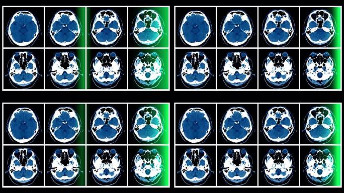绿光运动的CT脑镜头