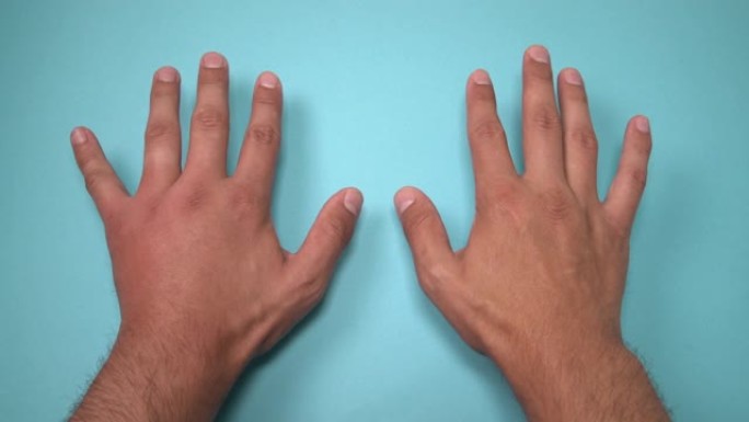 蜜蜂或黄蜂刺痛的两只雄性手的比较。手部肿胀、发炎、发红是感染的征兆。蓝色背景上左手的昆虫叮咬