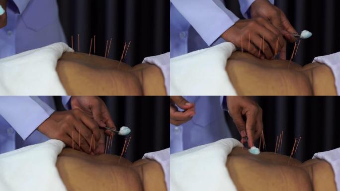 针灸治疗过程中使用钢针对高级女性背部进行特写