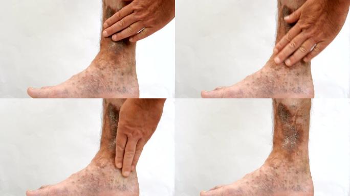 人的手触摸和划伤疤痕，溃疡和老年斑，可能是在他的腿静脉曲张后。