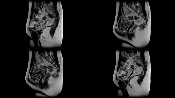 腹腔，胃肠道，膀胱的对比MRI