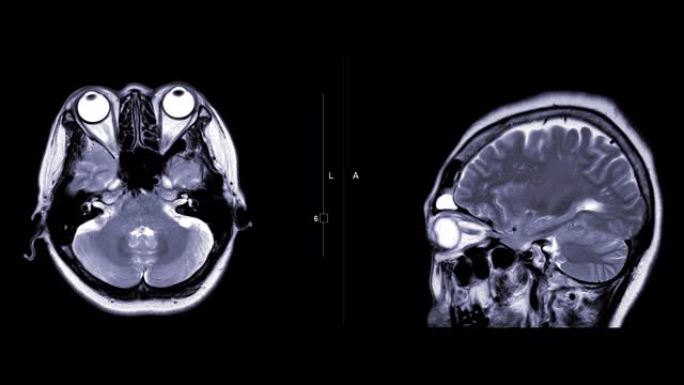 MRI脑或脑的磁共振成像 (MRI) 将轴向和矢状面与g造影剂进行比较。