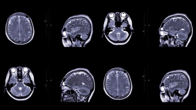 MRI脑或脑的磁共振成像 (MRI) 将轴向和矢状面与g造影剂进行比较。
