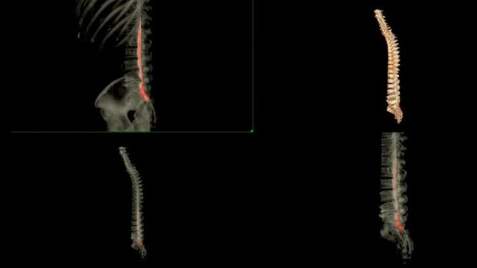 CT脊髓造影与整个脊柱3D渲染图像的比较对于从CT扫描仪检测压迫脊柱神经的小椎间盘突出症特别敏感。
