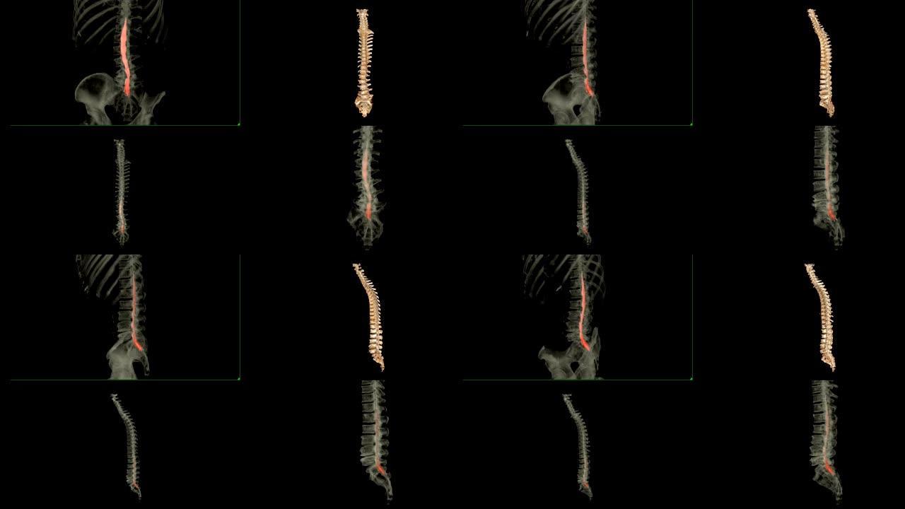 CT脊髓造影与整个脊柱3D渲染图像的比较对于从CT扫描仪检测压迫脊柱神经的小椎间盘突出症特别敏感。