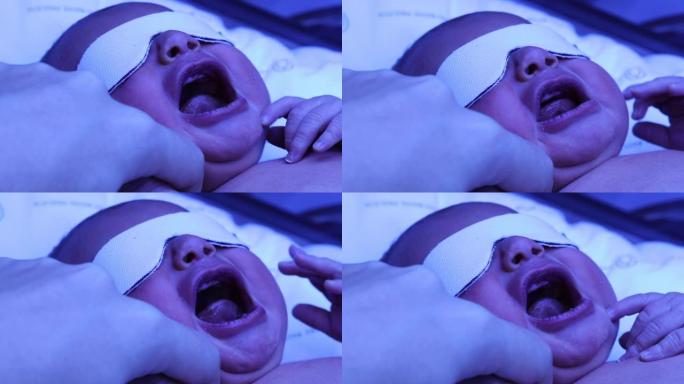 新生婴儿在光疗灯下哭泣。接受黄疸治疗