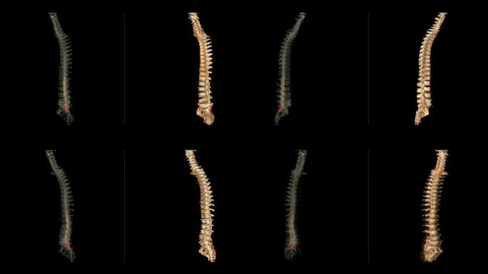 CT脊髓造影与整个脊柱3D渲染图像的比较对于从CT扫描仪检测压迫脊柱神经的小椎间盘突出症特别敏感。