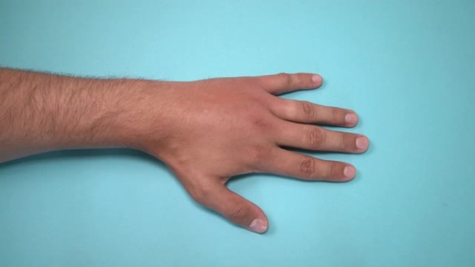 被蜜蜂或黄蜂蛰伤的雄性手。手部肿胀、发炎、发红是感染的征兆。左手昆虫叮咬