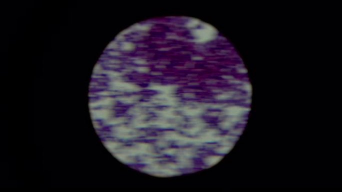 光镜下对二元裂变细菌团簇中革兰氏阳性葡萄球菌染色的人类生物样品培养物的涂片