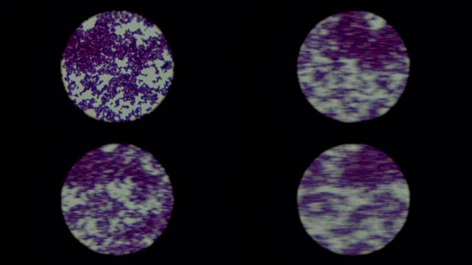 光镜下对二元裂变细菌团簇中革兰氏阳性葡萄球菌染色的人类生物样品培养物的涂片