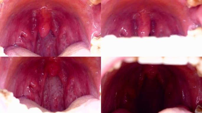扁桃体畸形，扁桃体炎，被忽视的人口腔内部不好，