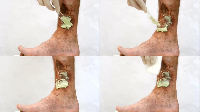 人的手涂药膏疤痕，溃疡和老年斑，可能是在他的腿静脉曲张后。