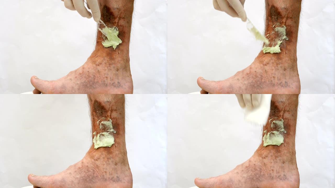人的手涂药膏疤痕，溃疡和老年斑，可能是在他的腿静脉曲张后。