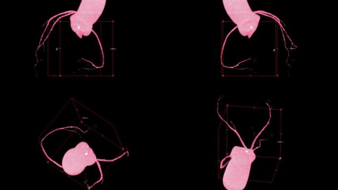 CTA冠状动脉3D渲染图像在屏幕上翻转以诊断血管冠状动脉狭窄。