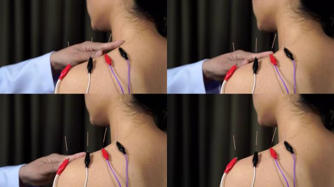 年轻女子接受肩部电刺激器的针灸治疗
