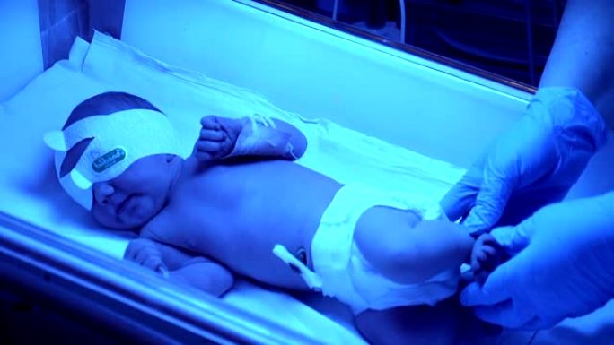 孵化器里的早产儿。新生儿可爱的婴儿婴儿，在医院托儿所用手握住脐带夹。高清