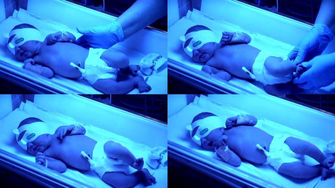 孵化器里的早产儿。新生儿可爱的婴儿婴儿，在医院托儿所用手握住脐带夹。高清