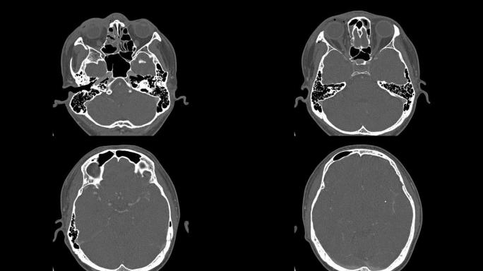 眼眶计算机断层扫描，男性，26岁交通事故移位骨折右眼眶外侧和内侧壁。医学图像。
