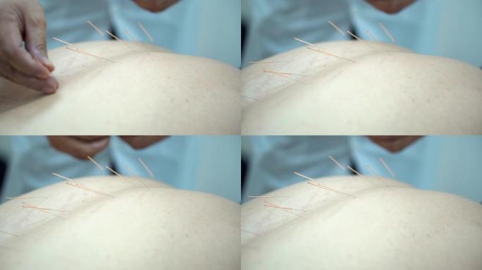 男子针灸特写。背部针灸针