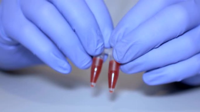 实验室的技术人员拿着移液管检测血液样本在病房进行输血，双手紧闭。医生拿着血液试管的特写。艾滋病/艾滋