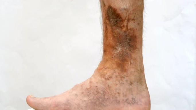 受皮肤皮肤病影响的人的足部有疤痕，溃疡和色素斑。