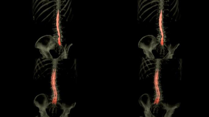 具有整个脊柱3D渲染图像的CT脊髓造影在从CT扫描仪检测压迫脊柱神经的小椎间盘突出症时特别敏感。