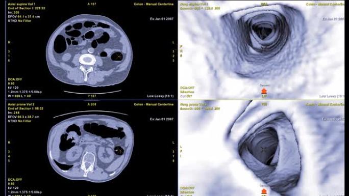 CT结肠造影比较轴向和3D电影文件筛查大肠癌。检查结肠癌筛查。