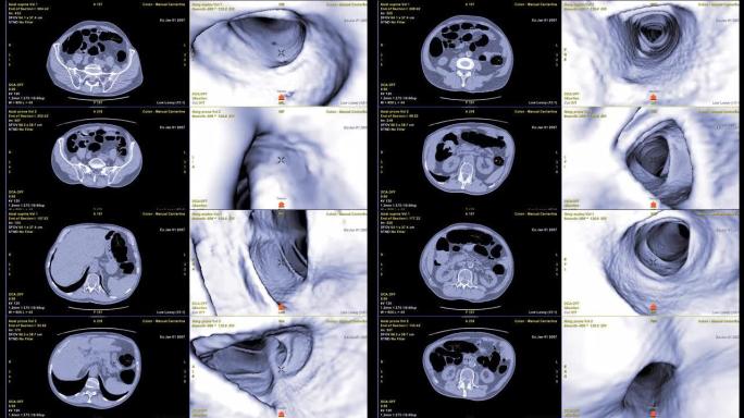 CT结肠造影比较轴向和3D电影文件筛查大肠癌。检查结肠癌筛查。