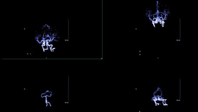 CTA脑或计算机断层扫描脑血管造影3D MIP显示脑的脑动脉。