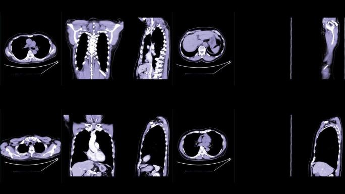 CT胸部对比或CTA肺动脉轴位NC，冠状位和矢状位可诊断肺栓塞和肺部疾病。