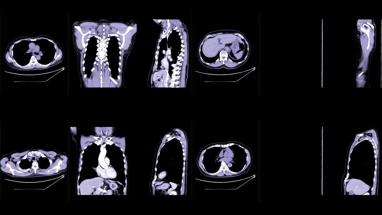 CT胸部对比或CTA肺动脉轴位NC，冠状位和矢状位可诊断肺栓塞和肺部疾病。
