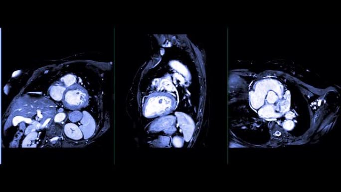 心脏平面MRI心脏或心脏MRI (磁共振成像) 显示心脏工作以检测心脏病。