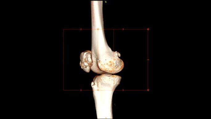 CT膝盖3D渲染图像在黑色背景上旋转，显示髌骨骨折。