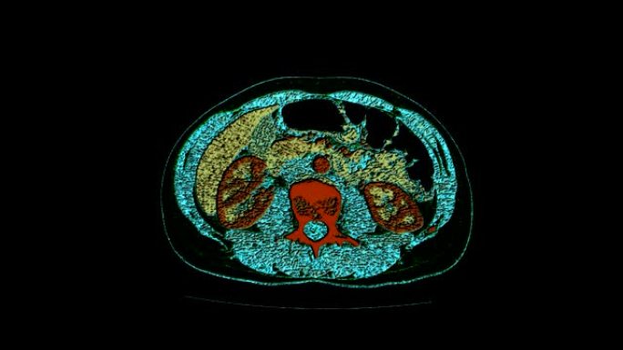 腹腔、胃肠道、膀胱的彩色对比MRI