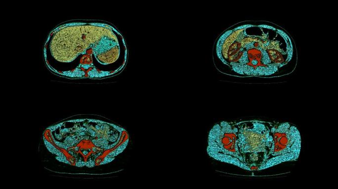 腹腔、胃肠道、膀胱的彩色对比MRI