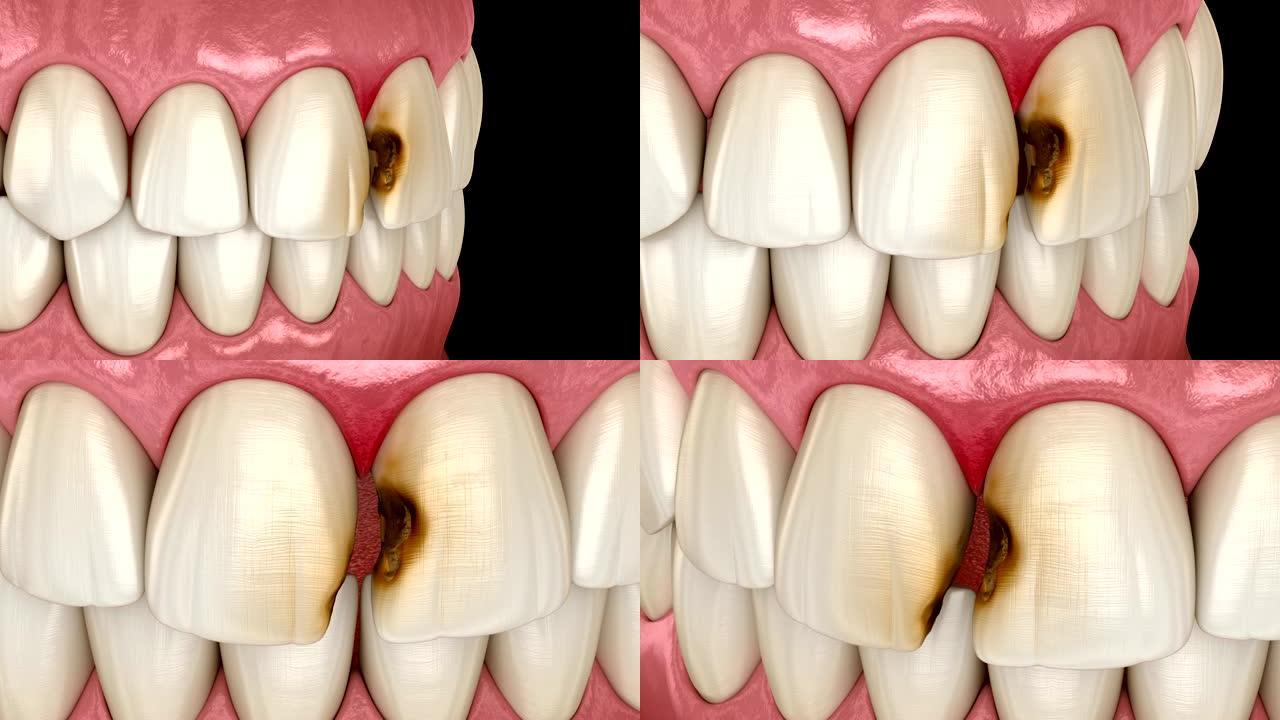 中切牙被龋齿损坏。医学上精确的牙齿3D动画。