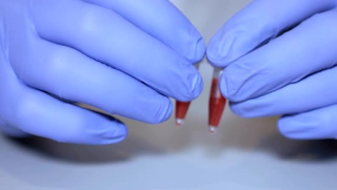 实验室的技术人员拿着移液管检测血液样本在病房进行输血，双手紧闭。医生拿着血液试管的特写。艾滋病/艾滋