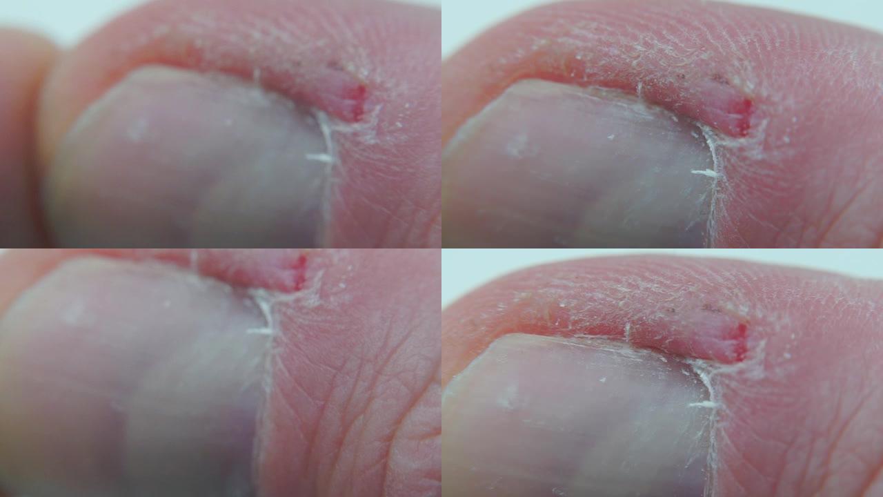 指甲附近的手指皮肤发炎。