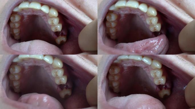 一名男子拔牙后用舌头检查出血的牙龈。失去臼齿。