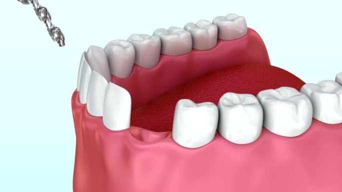 牙齿种植体安装过程，医学上精确的3d动画