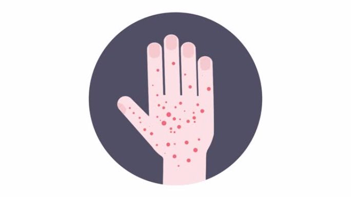 手部出现疹子的医学动画。