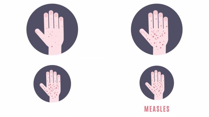 手部出现疹子的医学动画。