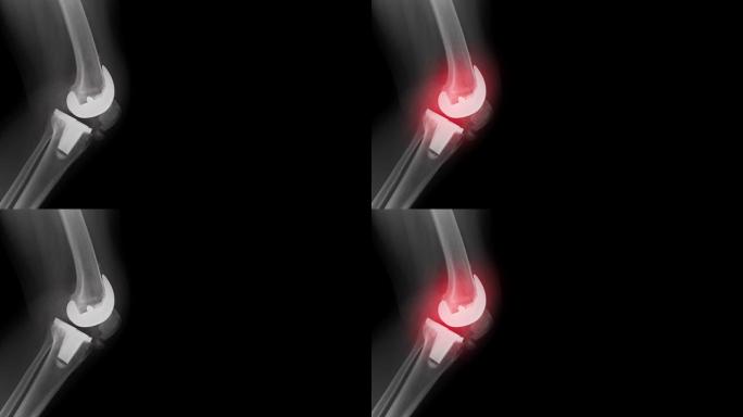 全膝关节置换术x线图像