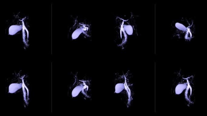 磁共振胰胆管造影或MRCP 3D MIP图像可视化胆管和胰管。